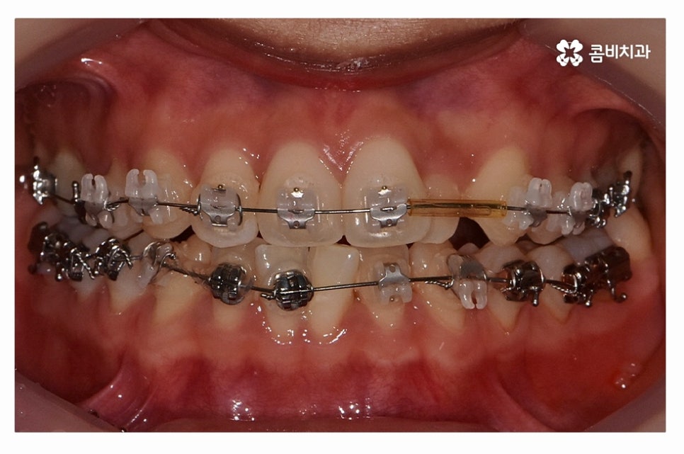 덧니교정 체계적으로 준비하려면 관련 이미지 5