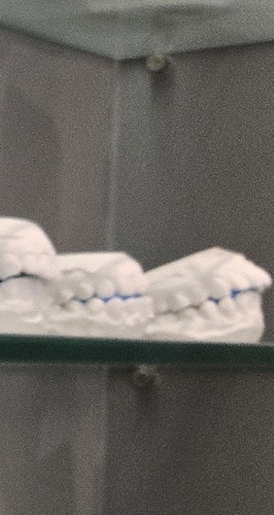 사랑니 주변 잇몸 통증 지금부터가 중요하니까 관련 이미지 30