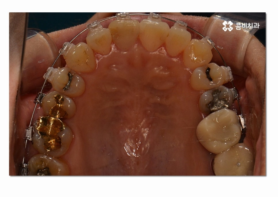3급 부정교합 지금이라도 고치고 싶다면 관련 이미지 8