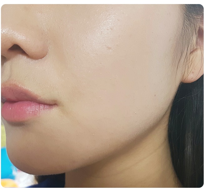 얼굴피지제거 놓치지 말아요 관련 이미지 5