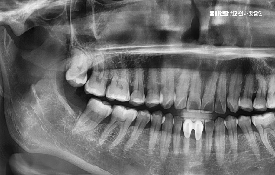사랑니 주변 잇몸 통증 지금부터가 중요하니까 관련 이미지 1