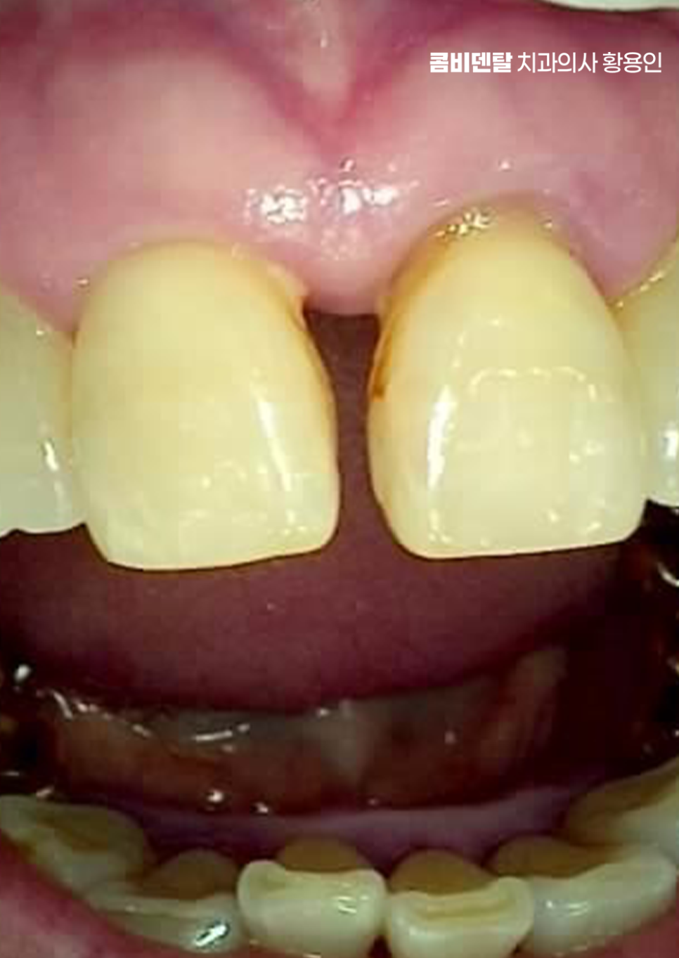 치아 사이 벌어짐 심해지는 이유부터 알아보면 관련 이미지 3