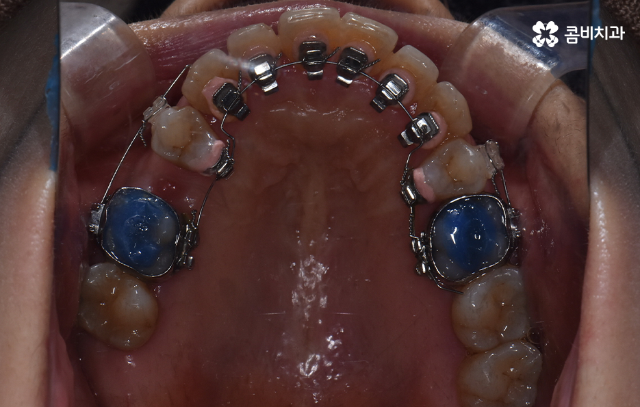 돌출입 콤비교정으로 얼굴까지 개선하는 방법은 관련 이미지 10