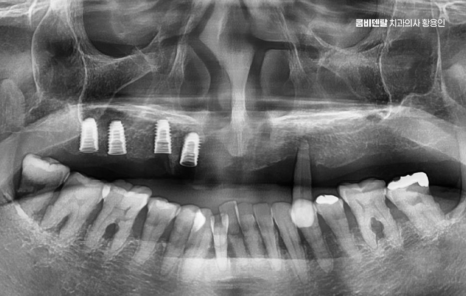 If You’re Considering Full Upper-Arch Implants for the Long Term image 3
