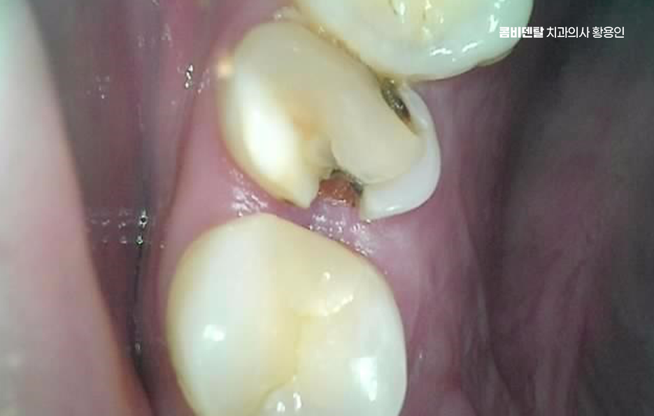 사랑니 발치 후 충치 치료 둘다 준비하려면 관련 이미지 3