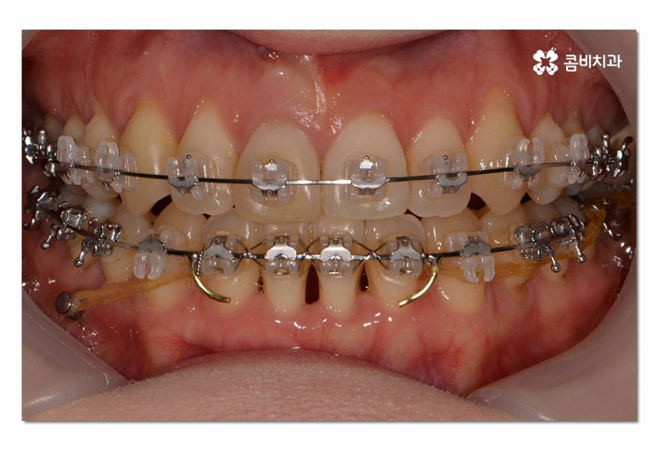 3급 부정교합 지금이라도 고치고 싶다면 관련 이미지 9