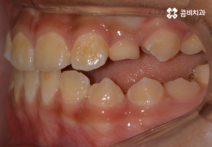 성장기치아교정 어떻게 접근하는 것이 좋을까 관련 이미지 5