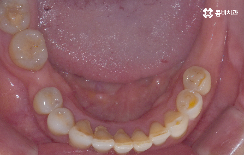 임플란트 해야 하는데 치아교정이 하고 싶다면 관련 이미지 6