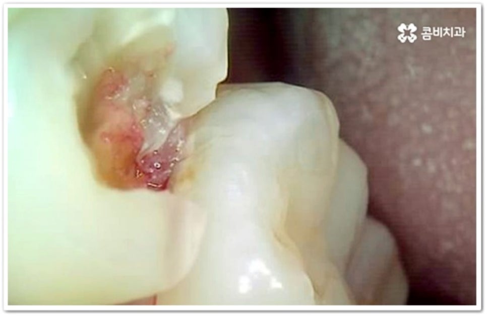 인접면 충치 어떻게 하나요 관련 이미지 7