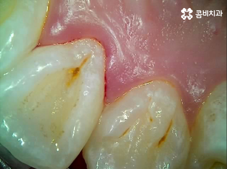앞니 충치치료 개인에 따라 달라지는 이유 관련 이미지 5