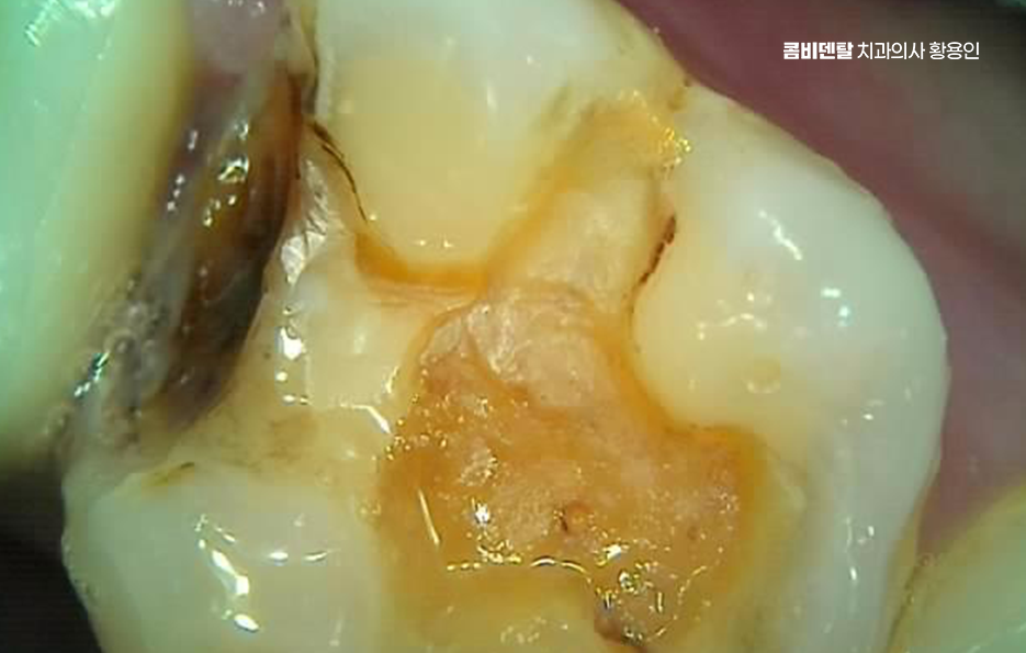 어금니 충치 단계 미리 알아차리려면 관련 이미지 12