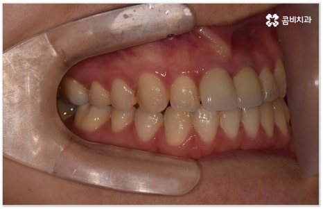 치아교정장치 어떻게 고르나요 관련 이미지 13