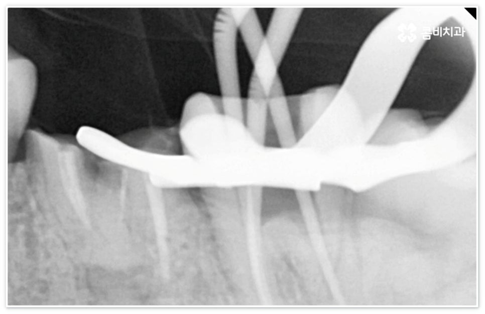 신경치료통증 무섭다고 미루면 관련 이미지 6