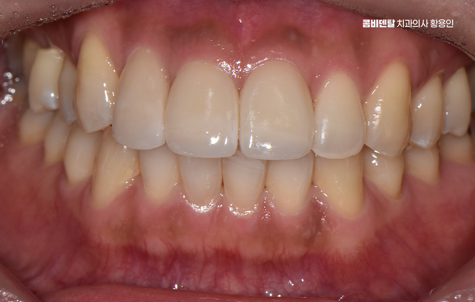 How to Use Laminate Veneers for Chipped Front Teeth image 8