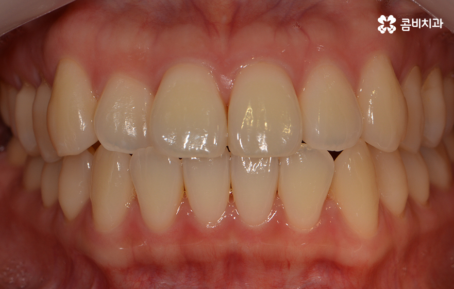 앞니치아교정 자연스러운 결과를 위해 알아둬야 할 점 관련 이미지 1