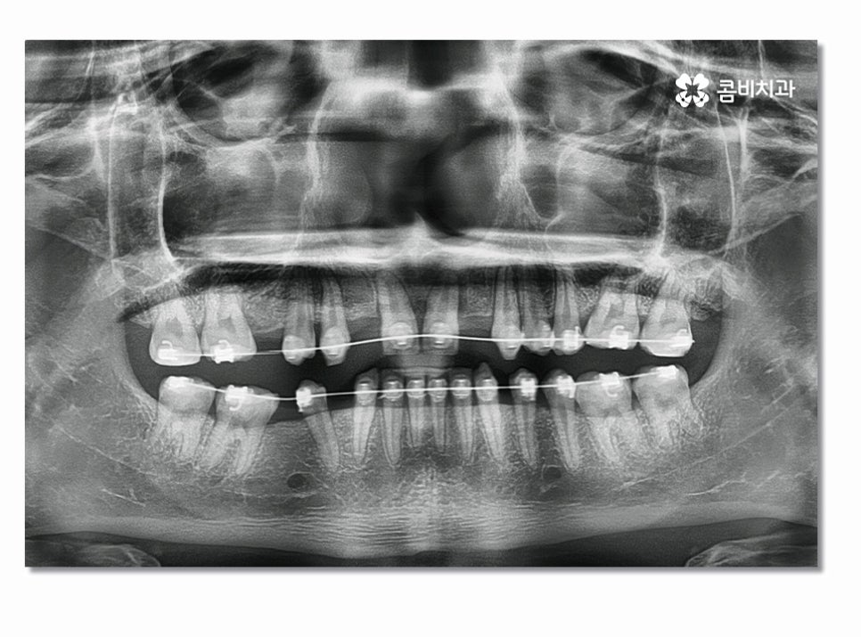 앞니임플란트 합리적으로 접근하려면 관련 이미지 2