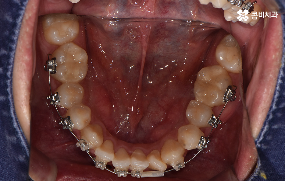 30대 치아교정 빨리 끝내고 싶어요 관련 이미지 10
