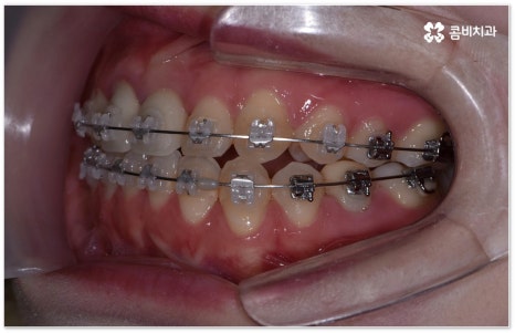 치아교정장치 어떻게 고르나요 관련 이미지 11