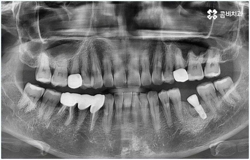 원데이임플란트 받고 싶으신가요? 관련 이미지 10