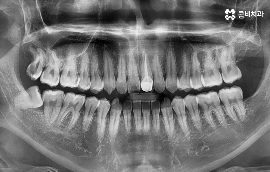 사랑니 발치 시기 이럴때 시작하면 좋아요 관련 이미지 5
