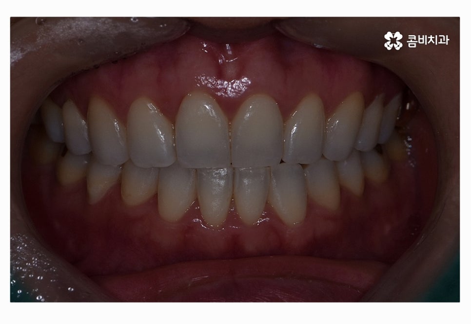 누런이로 고민하시는 분들을 위한 치아미백 정보 관련 이미지 2