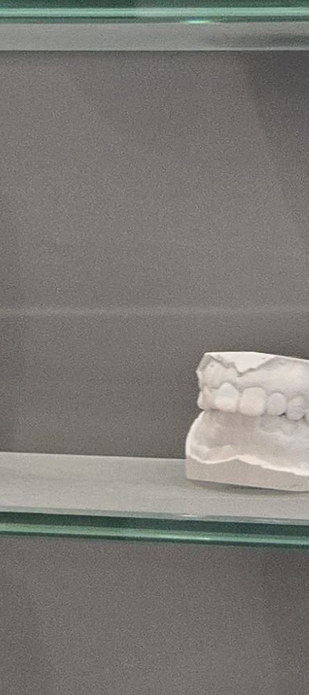 앞이빨 임플란트 과정 주의해야할 포인트는 관련 이미지 22