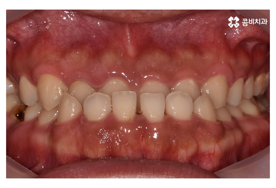 클리피씨교정 늦지않게 결정하려면 관련 이미지 1