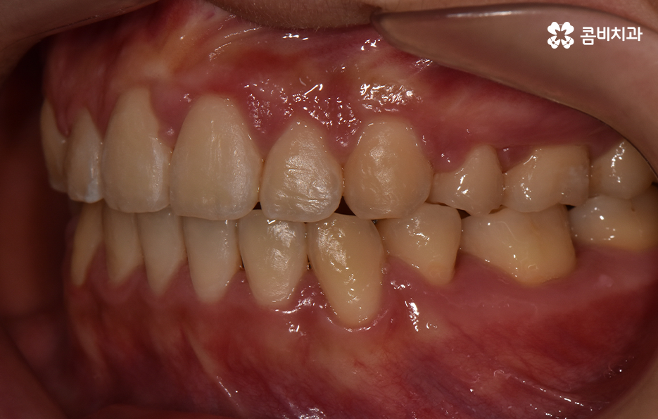 돌출입발치교정 기대해봐도 될까요 관련 이미지 12