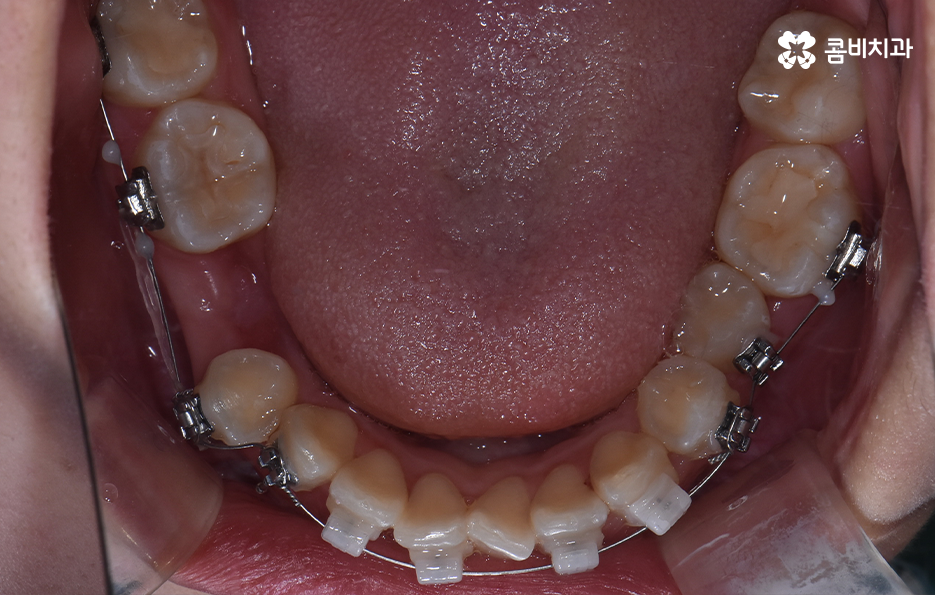 덧니 발치 교정 이런 경우에는 필요합니다 관련 이미지 11