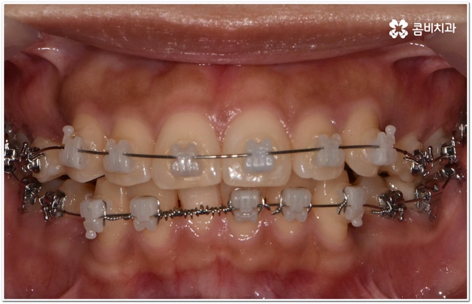 돌출입교정치과 알아보는 기준은 관련 이미지 7