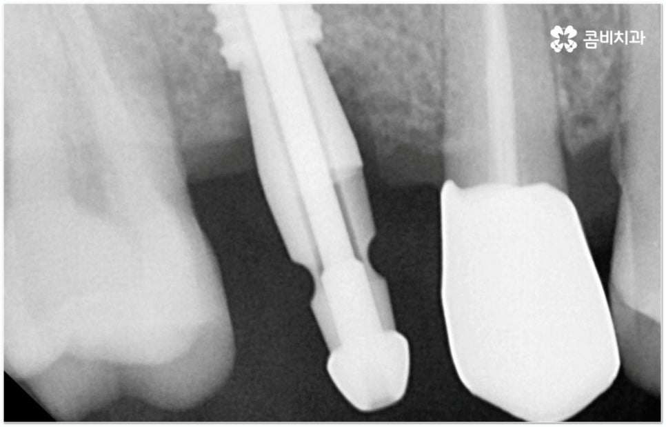 뼈이식임플란트 언제하나요? 관련 이미지 8
