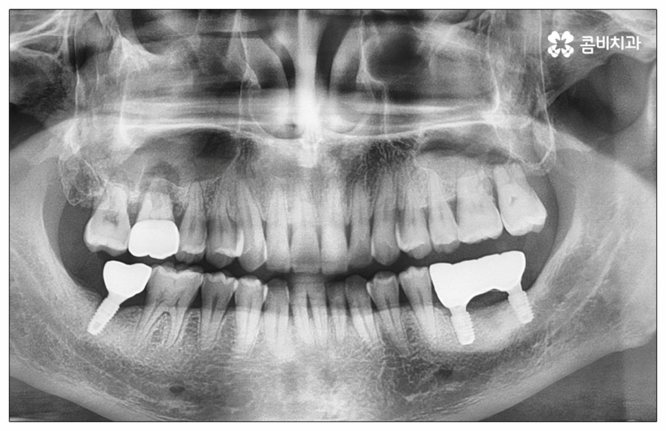 건강보험임플란트 혜택받아 보세요 관련 이미지 9