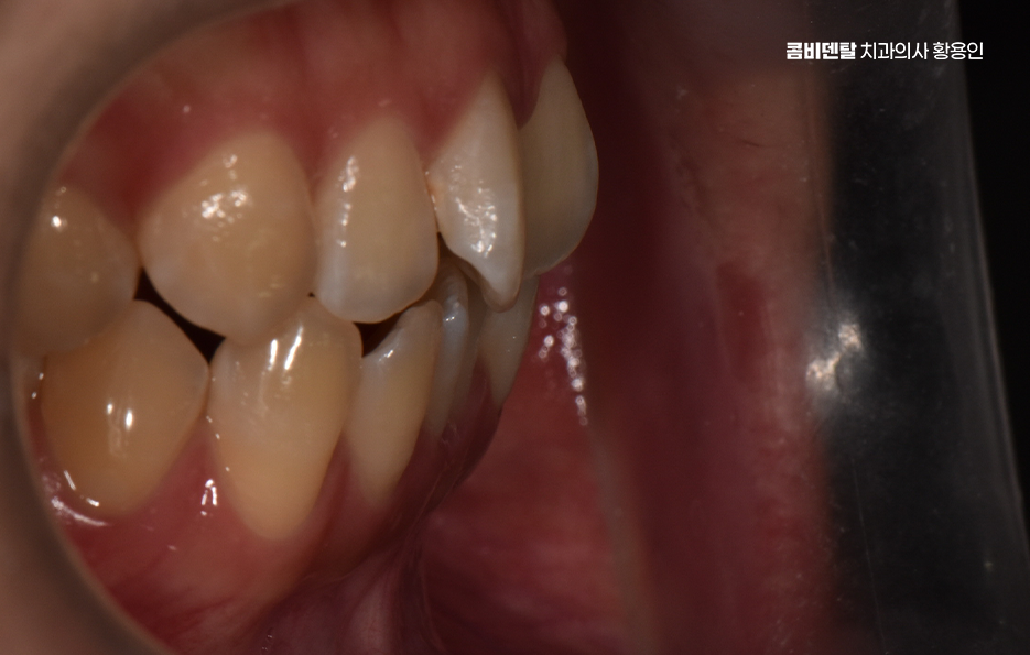 How Can You Determine the Duration of Front Teeth Orthodontic Treatment? image 3