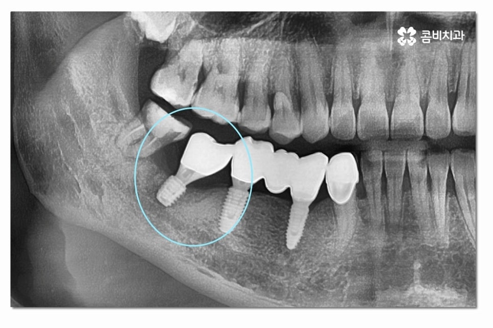 어금니임플란트 합리적으로 알아보려면 관련 이미지 8
