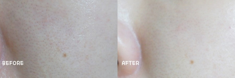 블랙헤드제거 간편하게 관리하세요~ 관련 이미지 11