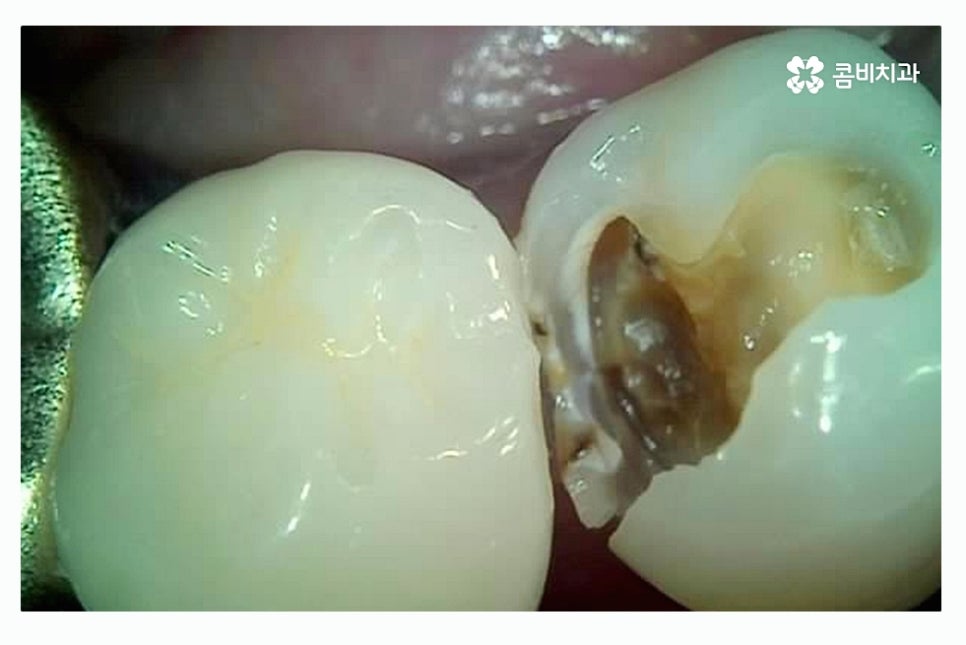 충치 레진 인레이 합리적으로 결정하려면 관련 이미지 9
