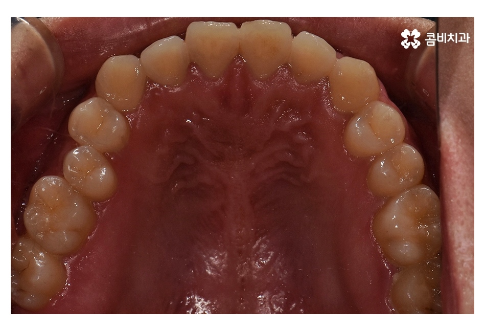 클리피씨교정 늦지않게 결정하려면 관련 이미지 4