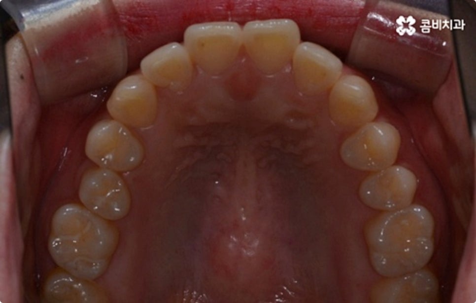 직장인치아교정 어떻게 시작하나요? 관련 이미지 4