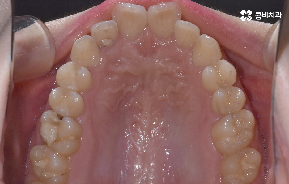 앞니 틀어짐 교정으로 해결하면 될까요 관련 이미지 5