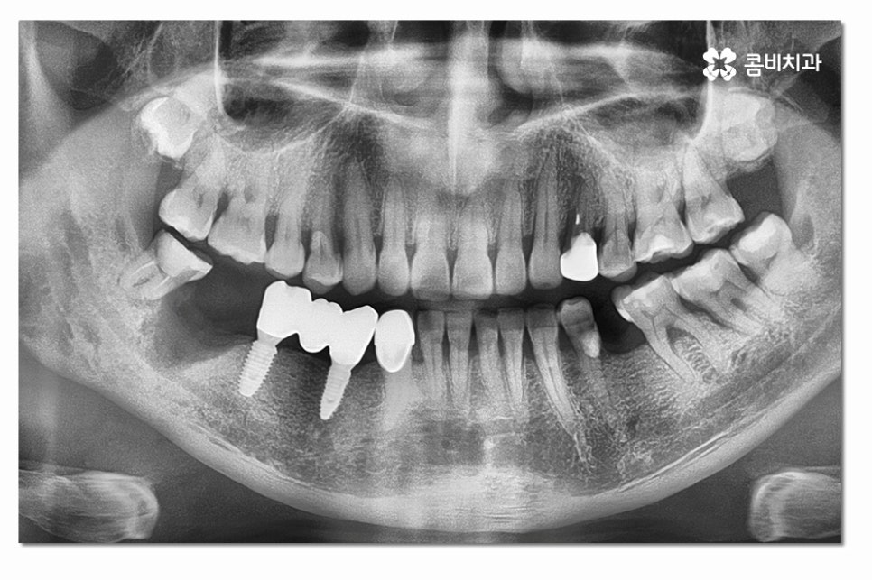 어금니임플란트 합리적으로 알아보려면 관련 이미지 2