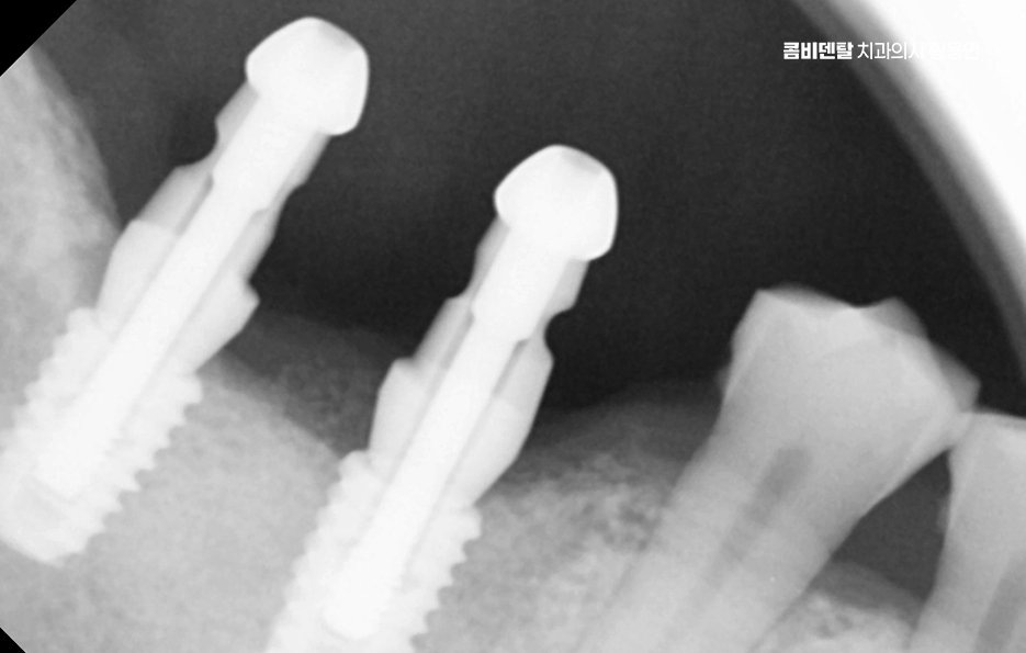 어금니 임플란트 과정 제대로 이해하려면 관련 이미지 8