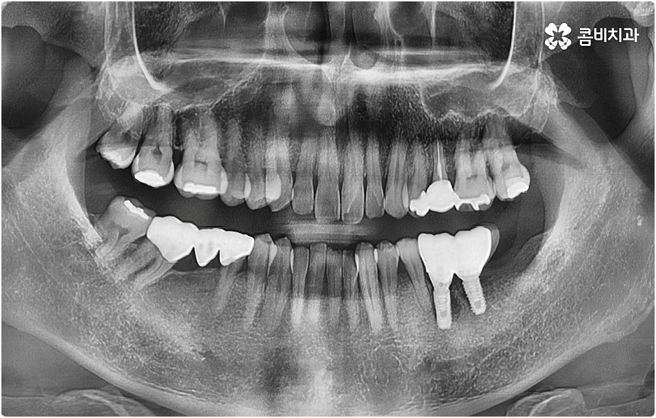 20대임플란트 남의일이 아니라면 관련 이미지 7
