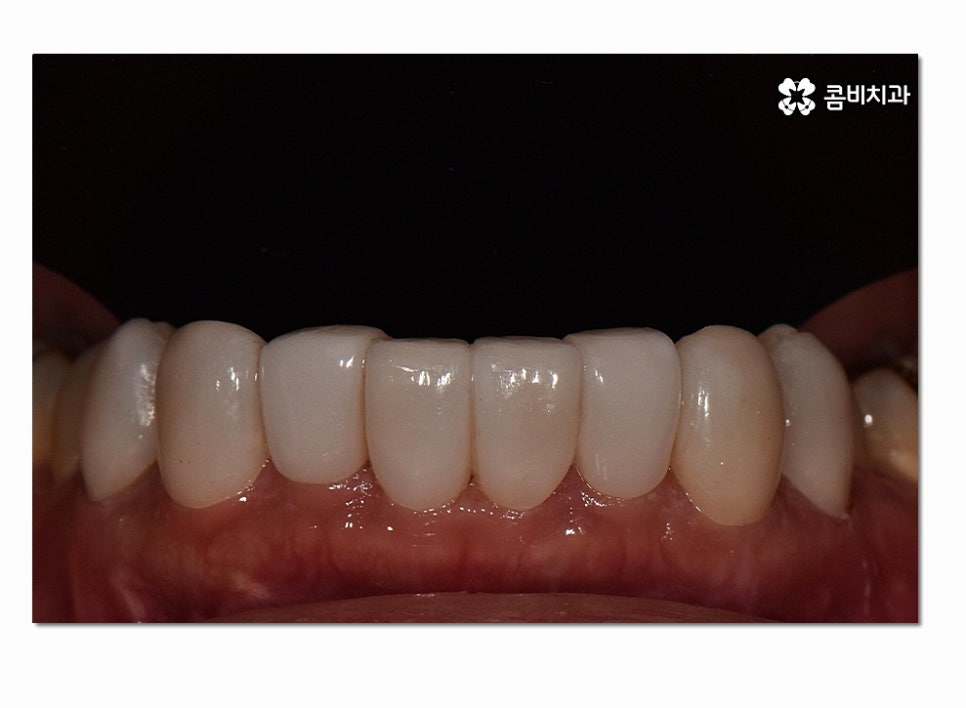 치아라미네이트 누구에게 필요할지 궁금하다면 관련 이미지 9