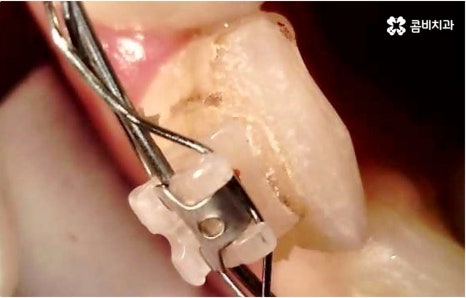 명동치과 타고난 이의 수명은 관련 이미지 16