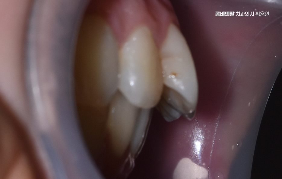 앞니 틀어짐 부분교정 얼마나 걸릴까 관련 이미지 2