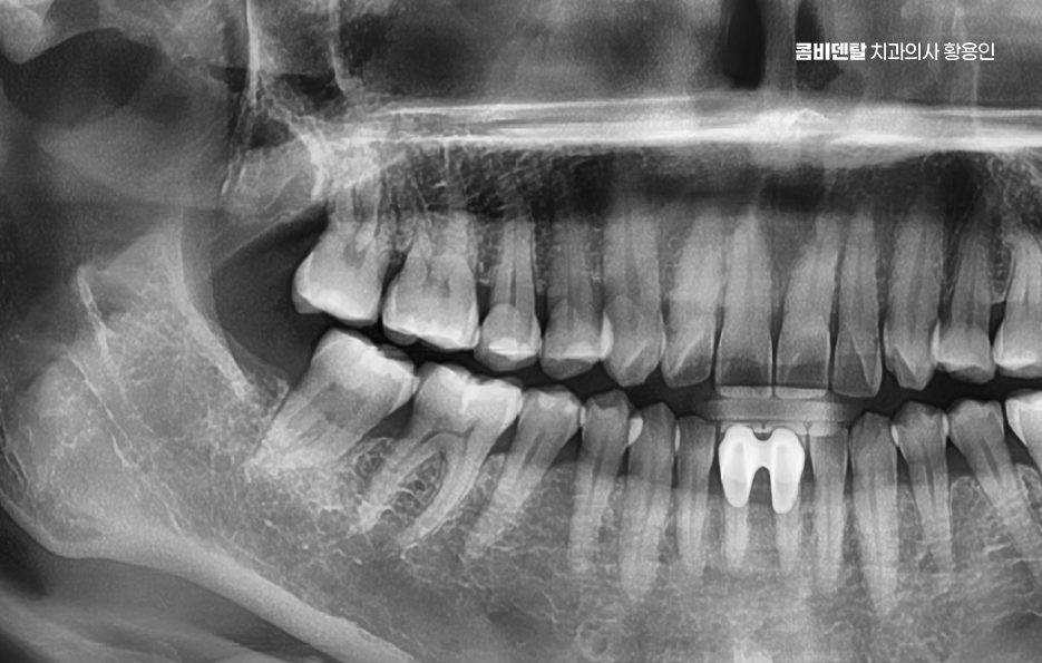 사랑니 주변 잇몸 통증 지금부터가 중요하니까 관련 이미지 10