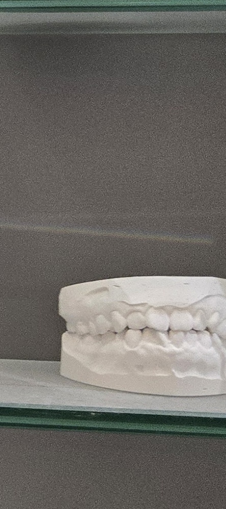 앞이빨 임플란트 과정 주의해야할 포인트는 관련 이미지 25