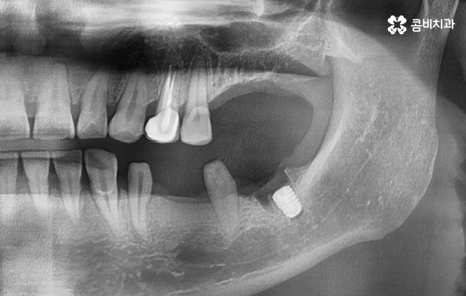 40대임플란트 치과에 이건 알고 가세요 관련 이미지 7