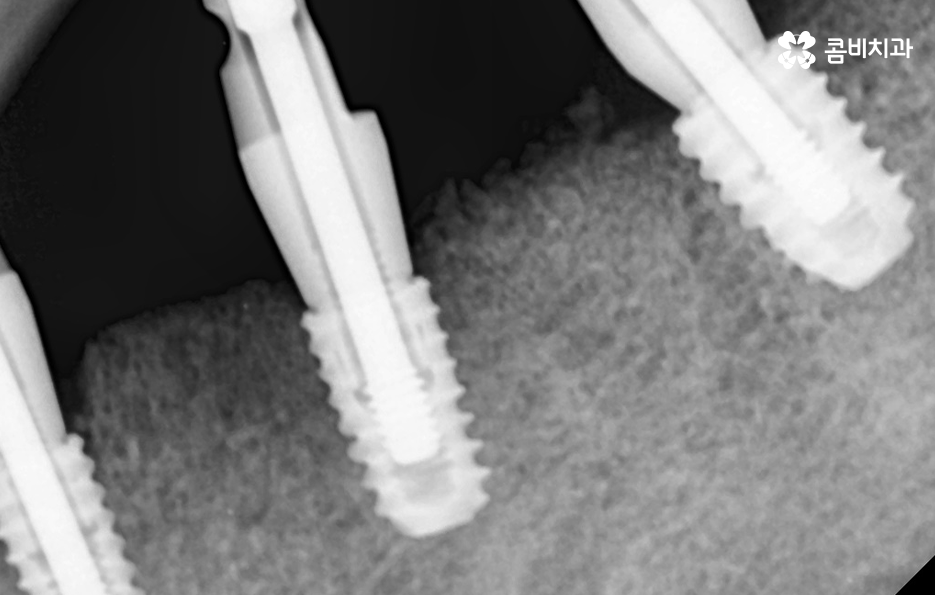 임플란트 치조골 상태에 따라 치료 계획도 달라지나요 관련 이미지 7