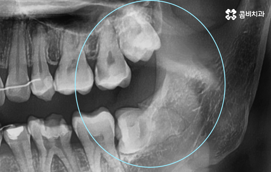 사랑니 어금니 통증 동시에 아프다면 관련 이미지 2